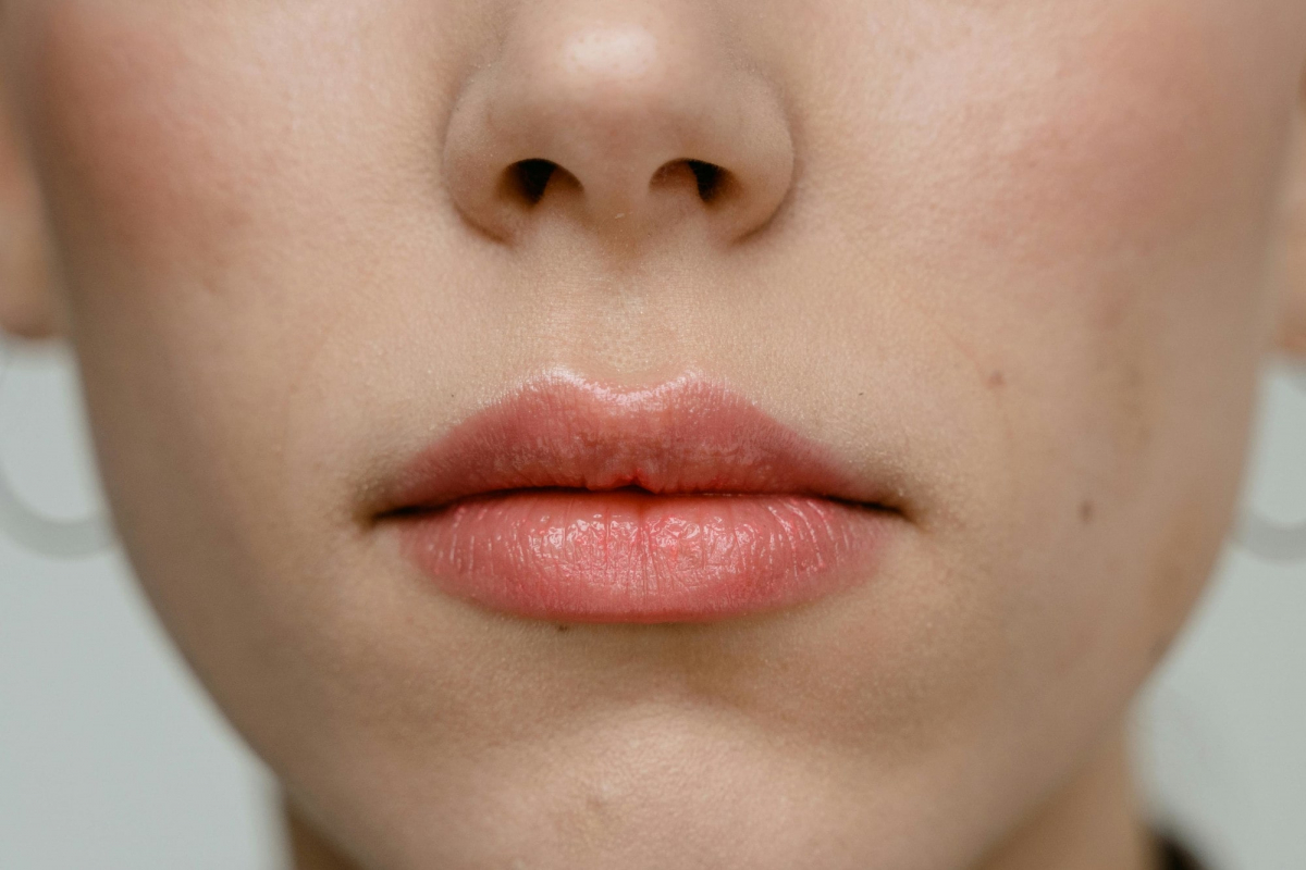 Injections Lèvres à Lyon | Acide Hyaluronique, Remodelage, Volume