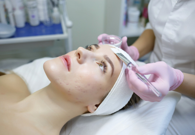 Traiter les cicatrices d'acné avec le peeling au TCA