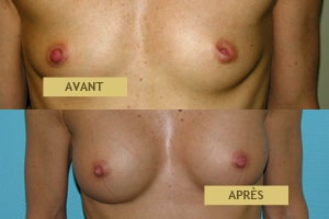 Résultats avant après d'augmentation mammaire par implants à Lyon