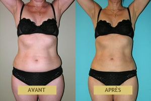 Cas clinique avant après de liposuccion pour femme à Lyon