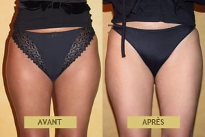 Cas clinique de liposuccion avant après pour femme à Lyon