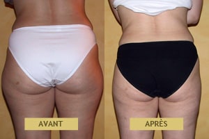 Cas clinique, résultat avant après de liposuccion pour femme à Lyon