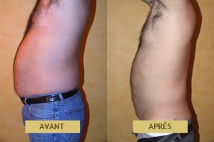 Cas clinique, résultat avant après de liposuccion pour homme à Lyon