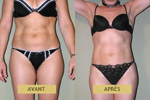 Résultat de cas clinique de liposuccion avant après pour femme à Lyon