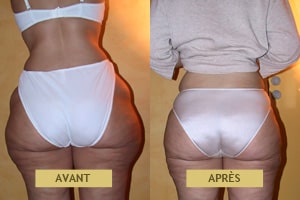 Résultat de cas clinique de liposuccion pour femme à Lyon