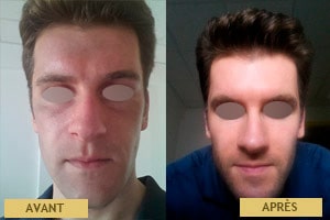 Cas clinique, résultat avant après de traitement au peeling à Lyon
