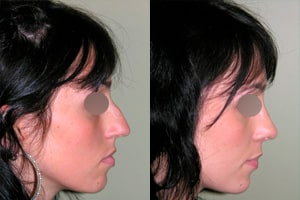 Chirurgie du nez ou rhinoplastie à Lyon