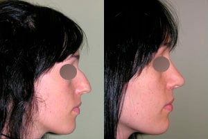 Chirurgie du nez ou rhinoplastie