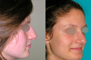 Chirurgie du nez à Lyon