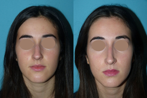 Chirurgie esthetique rhinoplastie du nez
