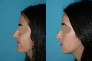 Chirurgie esthetique rhinoplastie du nez à Lyon