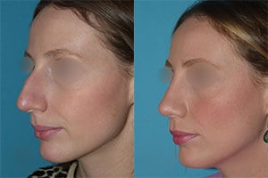 Résultat avant après de rhinoplastie chirurgicale à Lyon