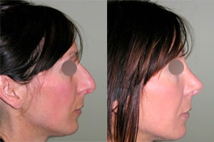 Résultat avant après de rhinoplastie chirurgicale femme