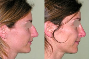 Résultat avant après de rhinoplastie chirurgicale pour femme