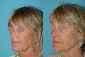Rhinoplastie chirurgie esthetique du nez femme profil