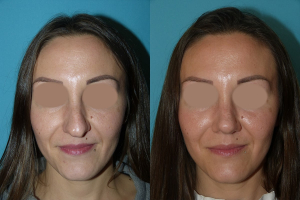 Rhinoplastie chirurgie esthetique du nez femme