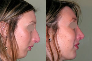 Résultat avant après de rhinoplastie à Lyon