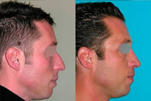 Cas clinique avant après rhinoplastie homme à Lyon