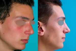 Résultat cas clinique avant après rhinoplastie homme à Lyon