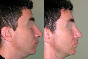 Résultat avant après de rhinoplastie homme à Lyon